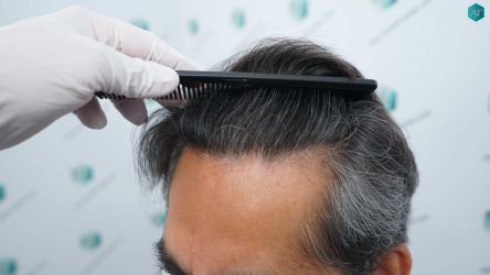 Injerto Capilar Técnica FUE Grafts 5326 (13645 Pelos) 71 84 RESULTADOS A LOS 12 MESES