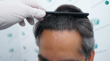 Injerto Capilar Técnica FUE Grafts 5326 (13645 Pelos) 72 85 RESULTADOS A LOS 12 MESES