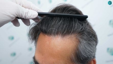 Injerto Capilar Técnica FUE Grafts 5326 (13645 Pelos) 73 86 RESULTADOS A LOS 12 MESES
