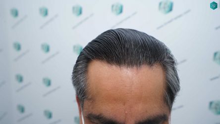 Injerto Capilar Técnica FUE Grafts 5326 (13645 Pelos) 74 87 RESULTADOS A LOS 12 MESES