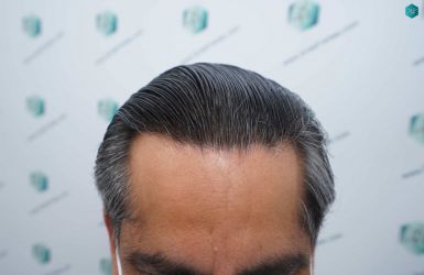 Injerto Capilar Técnica FUE Grafts 5326 (13645 Pelos) 75 87A RESULTADOS A LOS 12 MESES