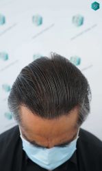 Injerto Capilar Técnica FUE Grafts 5326 (13645 Pelos) 76 87AB RESULTADOS A LOS 12 MESES