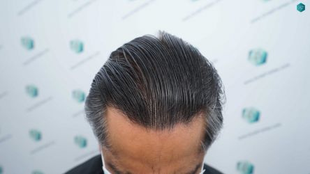 Injerto Capilar Técnica FUE Grafts 5326 (13645 Pelos) 77 88 RESULTADOS A LOS 12 MESES