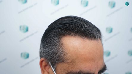 Injerto Capilar Técnica FUE Grafts 5326 (13645 Pelos) 78 89 RESULTADOS A LOS 12 MESES