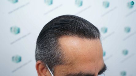 Injerto Capilar Técnica FUE Grafts 5326 (13645 Pelos) 79 89A RESULTADOS A LOS 12 MESES