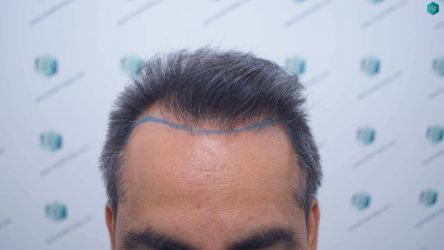 DISENO DE LA LINEA DEL TRASPLANTE DE PELO 9 DISENO DE LA LINEA DEL TRASPLANTE DE PELO