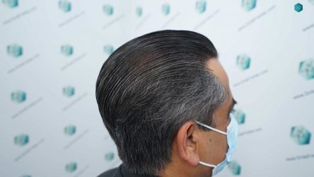 Injerto Capilar Técnica FUE Grafts 5326 (13645 Pelos) 80 90 RESULTADOS A LAS 12 MESES