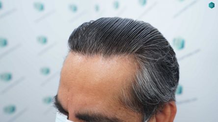 Injerto Capilar Técnica FUE Grafts 5326 (13645 Pelos) 81 90 RESULTADOS A LOS 12 MESES