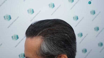 Injerto Capilar Técnica FUE Grafts 5326 (13645 Pelos) 82 90A RESULTADOS A LOS 12 MESES