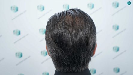 Injerto Capilar Técnica FUE Grafts 5326 (13645 Pelos) 83 90AB RESULTADOS A LOS 12 MESES