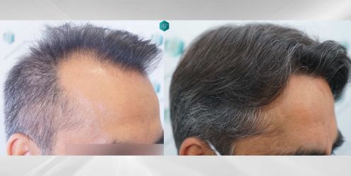 Injerto Capilar Técnica FUE Grafts 5326 (13645 Pelos) 84 91 COMPARATIVAS