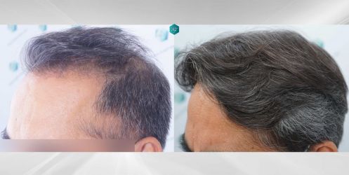 Injerto Capilar Técnica FUE Grafts 5326 (13645 Pelos) 85 92 COMPARATIVAS