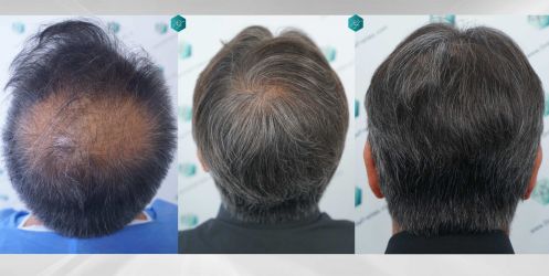 Injerto Capilar Técnica FUE Grafts 5326 (13645 Pelos) 86 93 COMPARATIVAS
