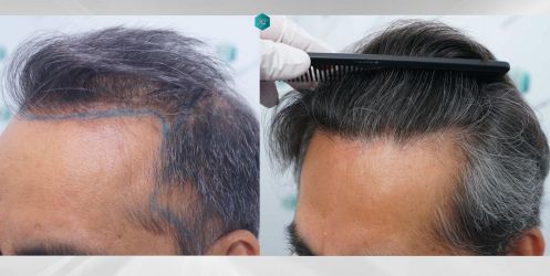 Injerto Capilar Técnica FUE Grafts 5326 (13645 Pelos) 87 94 COMPARATIVAS