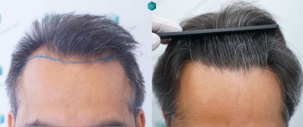 Injerto Capilar Técnica FUE Grafts 5326 (13645 Pelos) 88 95 COMPARATIVAS