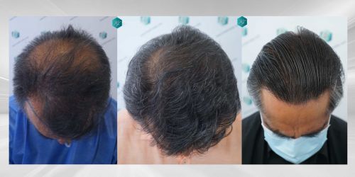 Injerto Capilar Técnica FUE Grafts 5326 (13645 Pelos) 89 96 COMPARATIVA