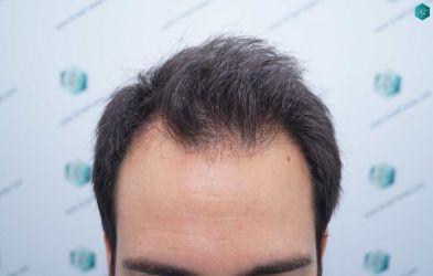 Injerto Capilar Técnica FUE Grafts 5158 (11924 Pelos) 1 02 ANTES DEL TRASPLANTE CAPILAR 1