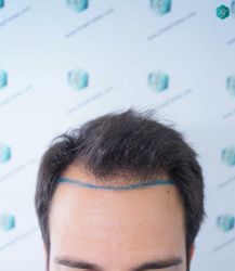 Injerto Capilar Técnica FUE Grafts 5158 (11924 Pelos) 7 10 DISENO LINEA DE INJERTO