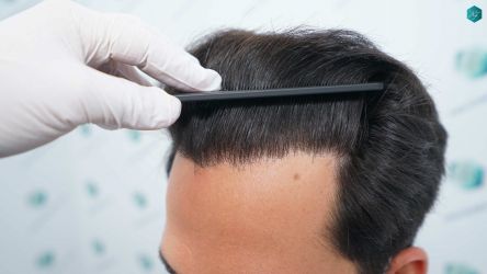 Injerto Capilar Técnica FUE Grafts 5158 (11924 Pelos) 64 100 RESULTADOS A LOS 12 MESES