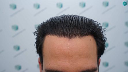 Injerto Capilar Técnica FUE Grafts 5158 (11924 Pelos) 66 102 RESULTADOS A LOS 12 MESES