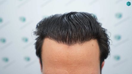 Injerto Capilar Técnica FUE Grafts 5158 (11924 Pelos) 67 102A RESULTADOS A LOS 12 MESES