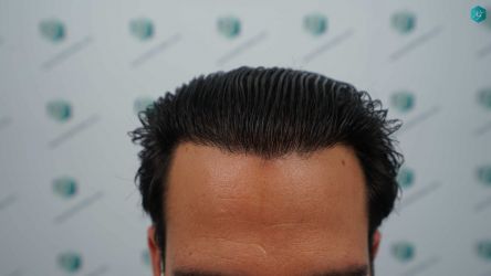 Injerto Capilar Técnica FUE Grafts 5158 (11924 Pelos) 68 103 RESULTADOS A LOS 12 MESES