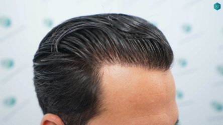 Injerto Capilar Técnica FUE Grafts 5158 (11924 Pelos) 69 104 RESULTADOS A LOS 12 MESES