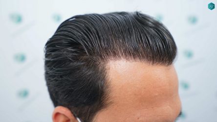 Injerto Capilar Técnica FUE Grafts 5158 (11924 Pelos) 70 105 RESULTADOS A LOS 12 MESES
