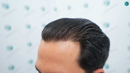 Injerto Capilar Técnica FUE Grafts 5158 (11924 Pelos) 71 106 RESULTADOS A LOS 12 MESES
