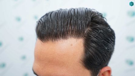 Injerto Capilar Técnica FUE Grafts 5158 (11924 Pelos) 72 107 RESULTADOS A LOS 12 MESES
