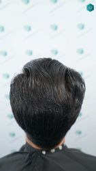 Injerto Capilar Técnica FUE Grafts 5158 (11924 Pelos) 73 108 RESULTADOS A LOS 12 MESES