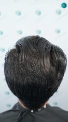 Injerto Capilar Técnica FUE Grafts 5158 (11924 Pelos) 74 109 RESULTADOS A LOS 12 MESES