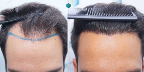 Injerto Capilar Técnica FUE Grafts 5158 (11924 Pelos) 75 111 COMPARATIVAS