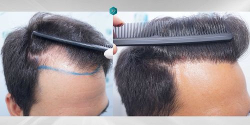 Injerto Capilar Técnica FUE Grafts 5158 (11924 Pelos) 76 112 COMPARATIVAS