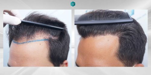 Injerto Capilar Técnica FUE Grafts 5158 (11924 Pelos) 77 113 COMPARATIVAS