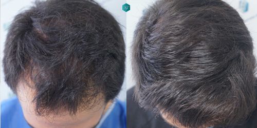 Injerto Capilar Técnica FUE Grafts 5158 (11924 Pelos) 78 114 COMPARATIVAS
