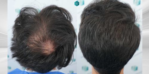 Injerto Capilar Técnica FUE Grafts 5158 (11924 Pelos) 79 115 COMPARATIVA