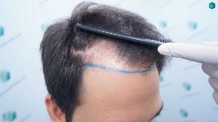 Injerto Capilar Técnica FUE Grafts 5158 (11924 Pelos) 9 12 DISENO LINEA DE INJERTO