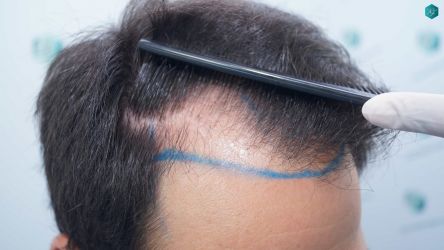 Injerto Capilar Técnica FUE Grafts 5158 (11924 Pelos) 10 13 DISENO LINEA DE INJERTO