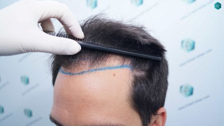 Injerto Capilar Técnica FUE Grafts 5158 (11924 Pelos) 11 14 DISENO LINEA DE INJERTO