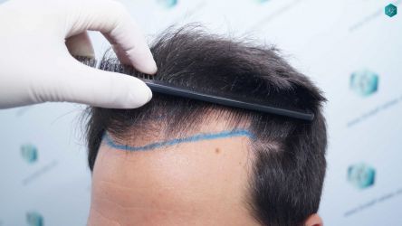Injerto Capilar Técnica FUE Grafts 5158 (11924 Pelos) 12 15 DISENO LINEA DE INJERTO