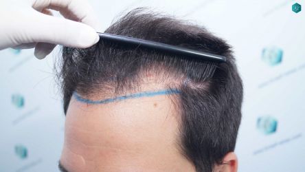 Injerto Capilar Técnica FUE Grafts 5158 (11924 Pelos) 13 16 DISENO LINEA DE INJERTO