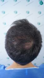 Injerto Capilar Técnica FUE Grafts 5158 (11924 Pelos) 15 18 DISENO LINEA DE INJERTO
