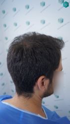 Injerto Capilar Técnica FUE Grafts 5158 (11924 Pelos) 16 19 DISENO LINEA DE INJERTO