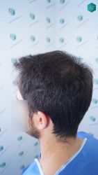 Injerto Capilar Técnica FUE Grafts 5158 (11924 Pelos) 17 20 DISENO LINEA DE INJERTO