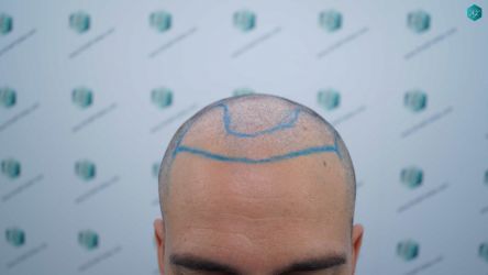 DISEÑO LINEA CON PELO RAPADO 21 DISENO LINEA DE INJERTO