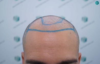 Injerto Capilar Técnica FUE Grafts 5158 (11924 Pelos) 18 24 DISENO LINEA DE INJERTO