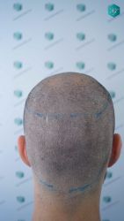 Injerto Capilar Técnica FUE Grafts 5158 (11924 Pelos) 20 28 DISENO LINEA DE INJERTO