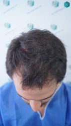 Injerto Capilar Técnica FUE Grafts 5158 (11924 Pelos) 2 3 ANTES DEL TRASPLANTE CAPILAR 1