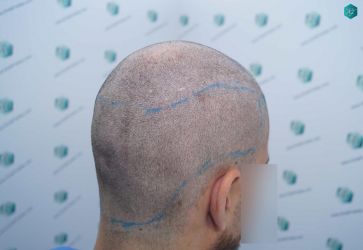 Injerto Capilar Técnica FUE Grafts 5158 (11924 Pelos) 22 30 DISENO LINEA DE INJERTO